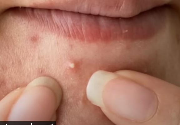 How to get rid of a pimple overnight 2