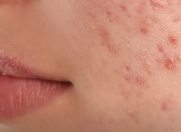 How to get rid of a pimple overnight title